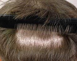 Slider image (2) AEK Hair Institute